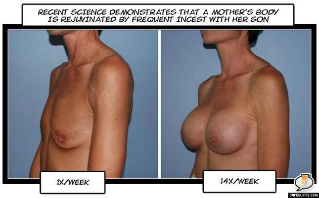 Mom tits - Before and After